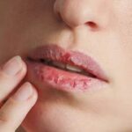 मानसून में पाएं फटे होंठों से राहत, आसान उपाय होंठों को रखें सॉफ्ट और हेल्दी